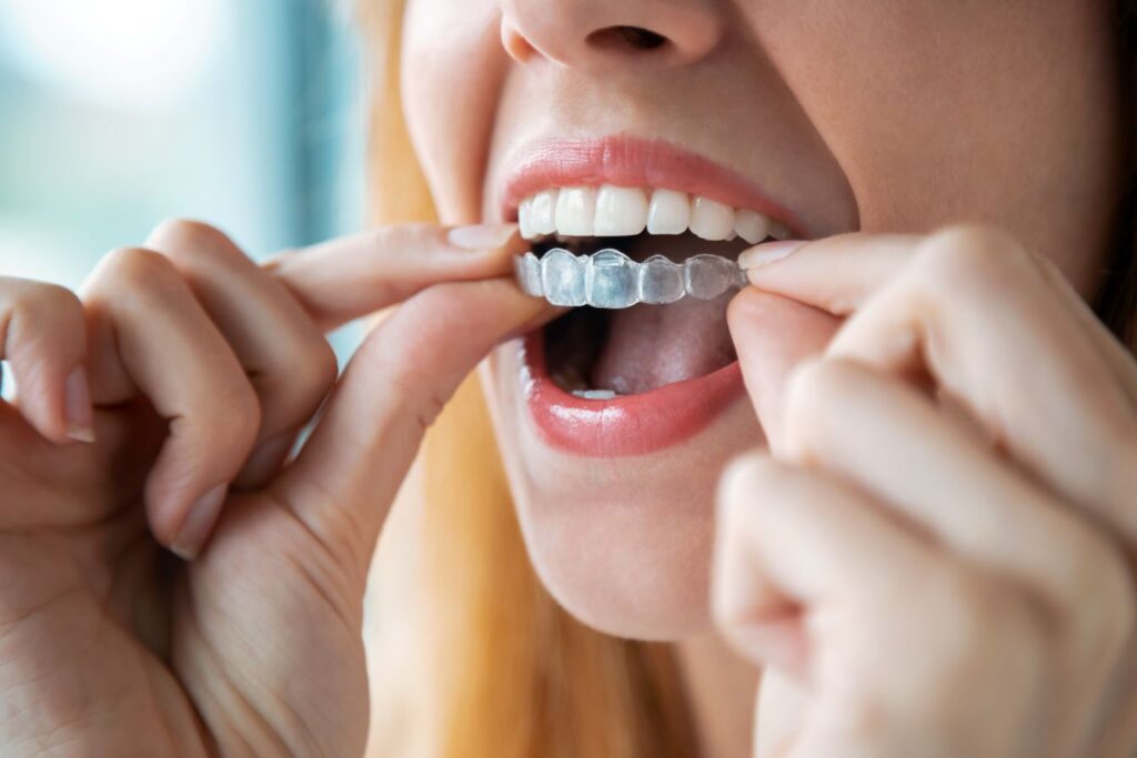 A woman putting on a Nu Smile aligner.